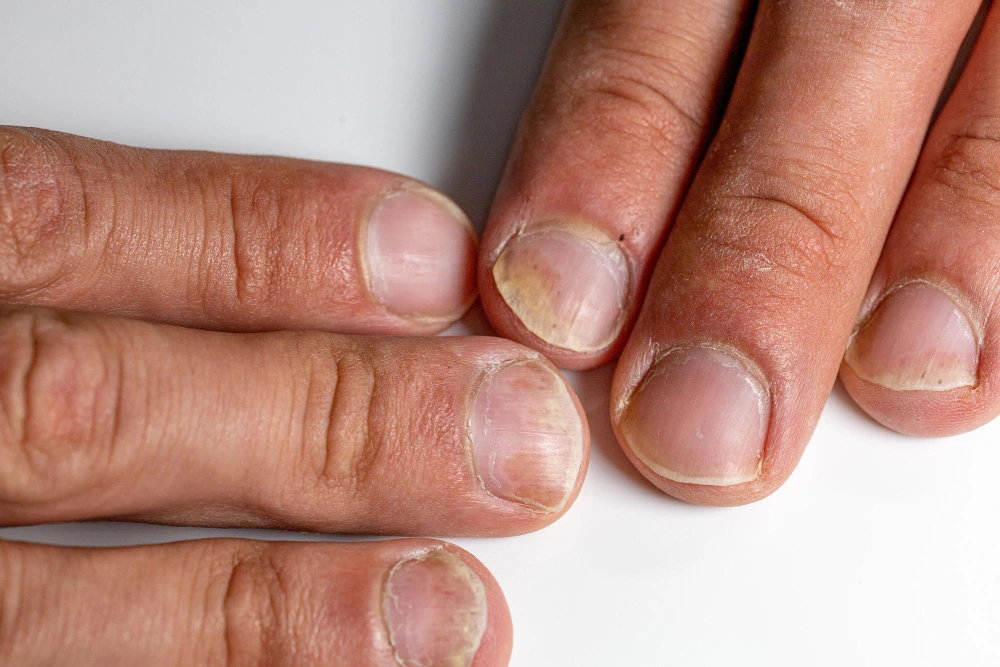 Early Detection of Nail Issues
