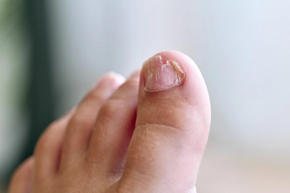 Prevents & Treats Nail Fungus